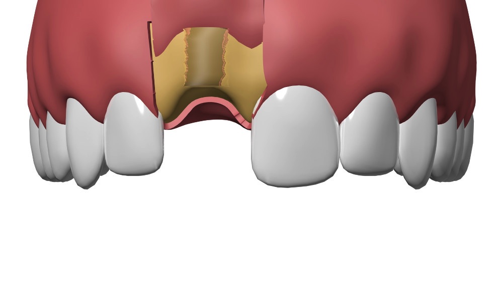 Cabinet dentaire Nimes implant dentaire